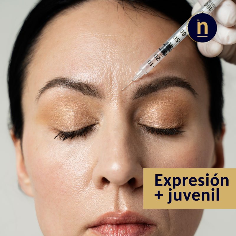 Imagen de ejemplo de la aplicación de neuromoduladores en la mitad superior de un rostro femenino.