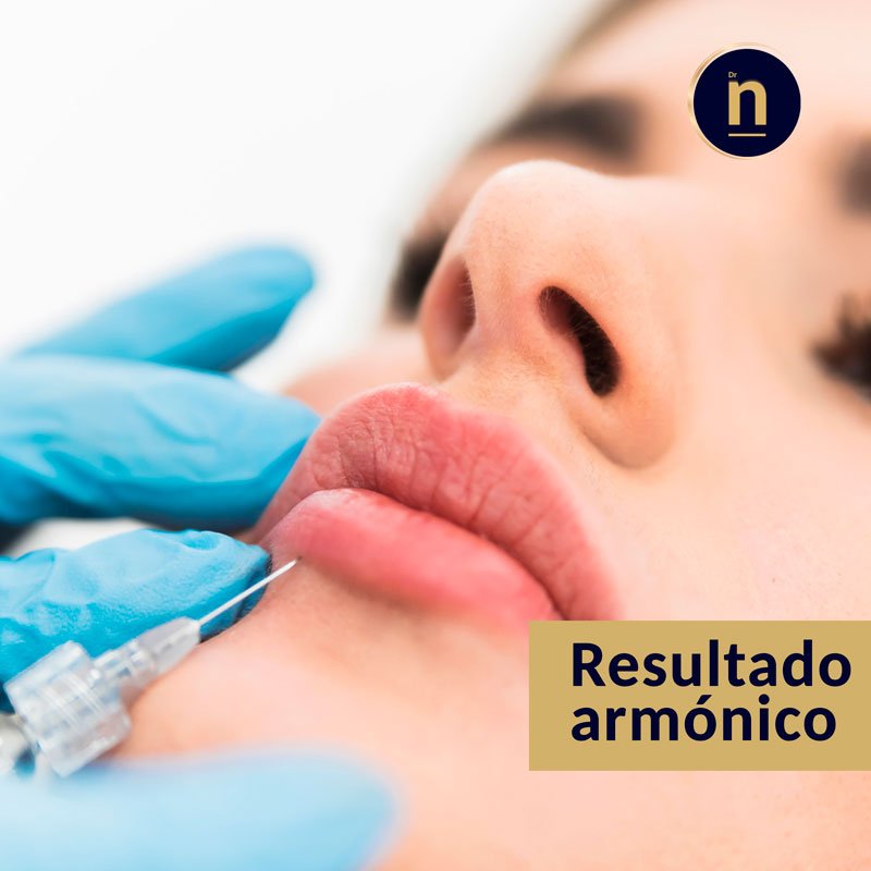 Imagen de una infiltración de ácido hialurónico en un tratamiento de labios médico estético.