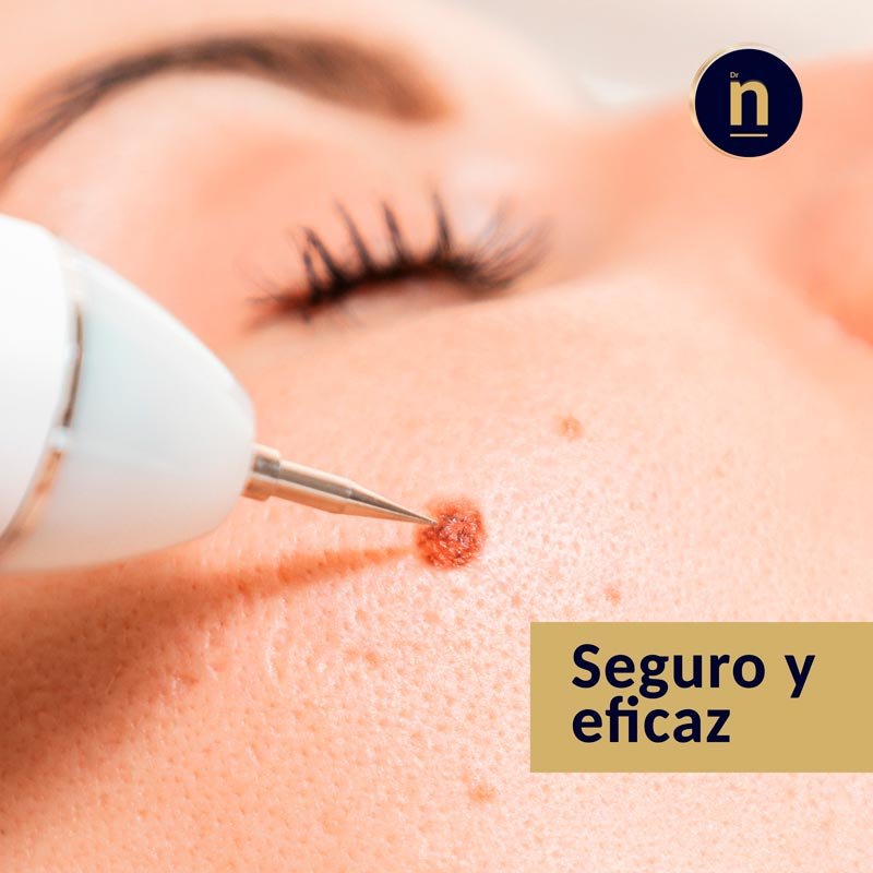 Tratamiento estético con láser plasmático para mejorar la calidad de la piel.