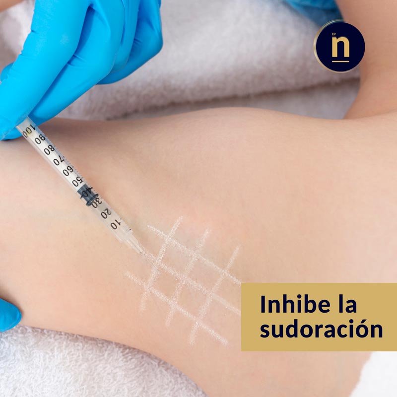 Tratamiento de la Hiperhidrosis con neuromoduladores.