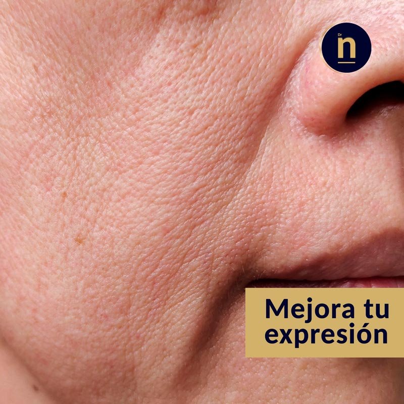 Tratamiento de las líneas de marioneta y pliegues de amargura con ácido hialurónico.