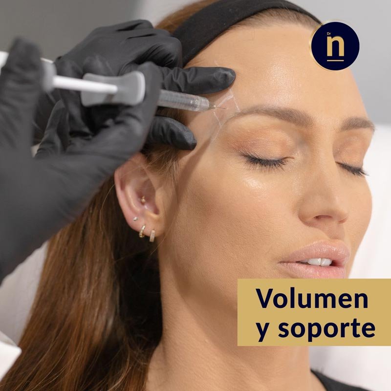 Tratamiento de relleno de zonas temporales con ácido hialurónico.